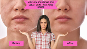 Kitchen Solutions for Clear Skin Fast Acne Relief